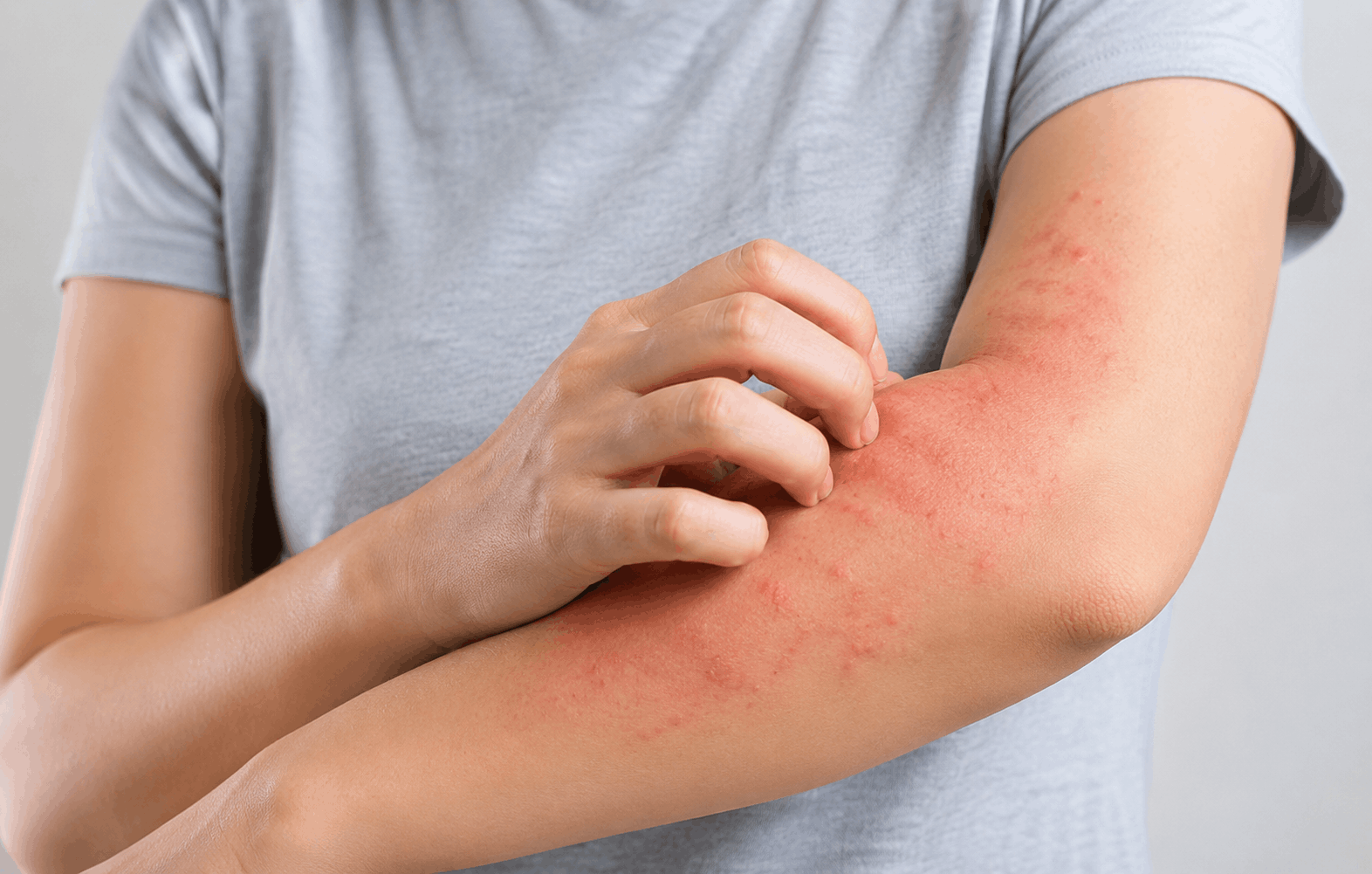 Skin Allergy